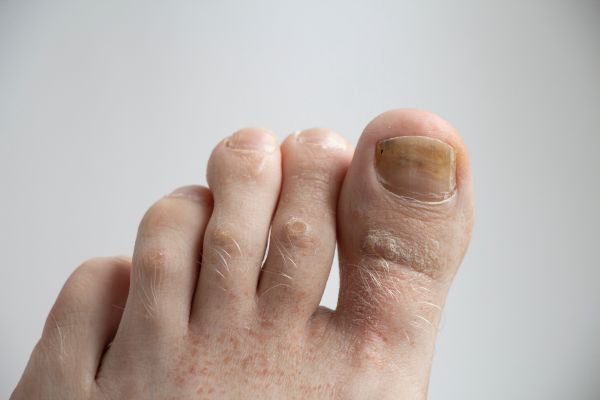 Simone_Militz_Podologia_Sao_Paulo_Unhas_encravadas_Frieiras_Tratamento_para _Calos20-Counter