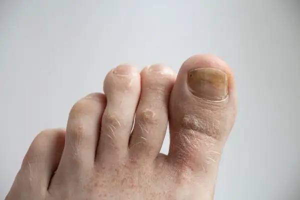 Simone_Militz_Podologia_Sao_Paulo_Unhas_encravadas_Frieiras_Tratamento_para _Calos20-Counter