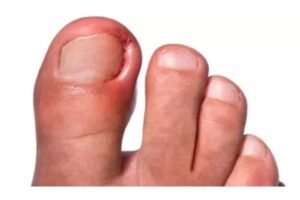 Simone_Militz_Podologia_Sao_Paulo_Unhas_encravadas_Frieiras_Tratamento_para _Calos20-Counter