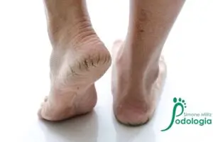 Fissuras ou rachaduras de calcanhar